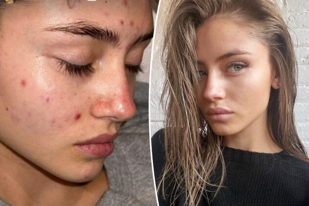 Leni Klum, 19, shares vulnerable makeup-free acne selfie
