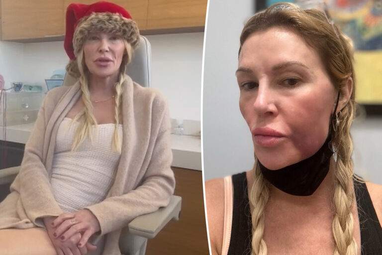 Brandi Glanville hasn’t had sex in over a year due to facial disfigurement: ‘I haven’t kissed or made out with anyone’