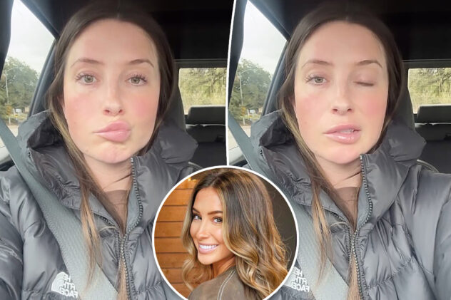 ‘Worried’ Bristol Palin reveals facial paralysis from neurological disorder ‘brought on by stress’