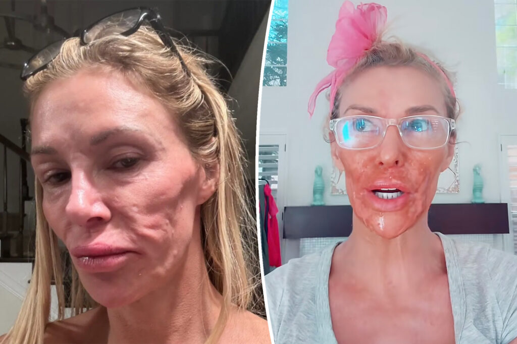 Brandi Glanville names her facial parasite after her ‘Real Housewives’ nemesis