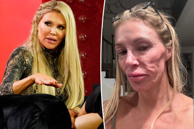Brandi Glanville shares exorbitant cost of trying to figure out years-long facial parasite mystery