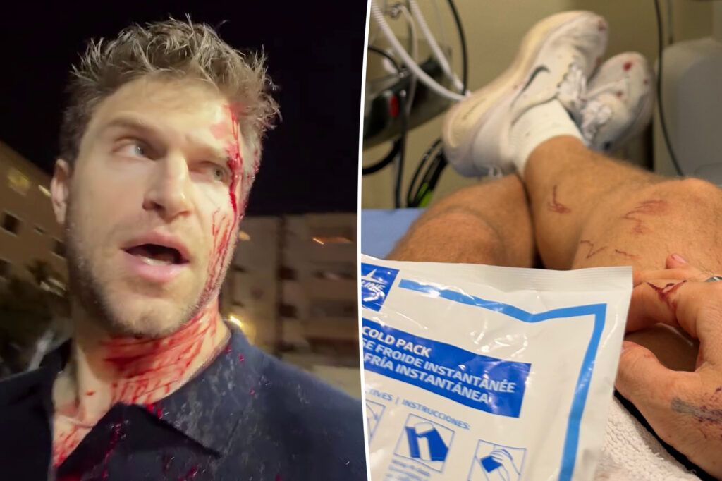 Keegan Allen posts painful photo after getting brutally robbed in LA: ‘I’m on the mend’